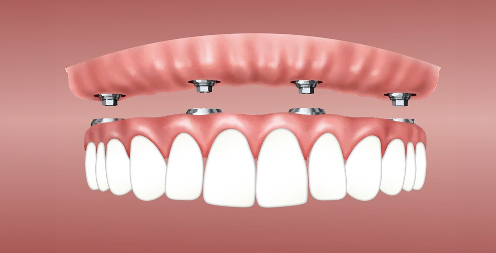 all-on-four-sonrasi-implantlarinizi-uzun-sure-saglikli-tutmanin-yollari-resim1