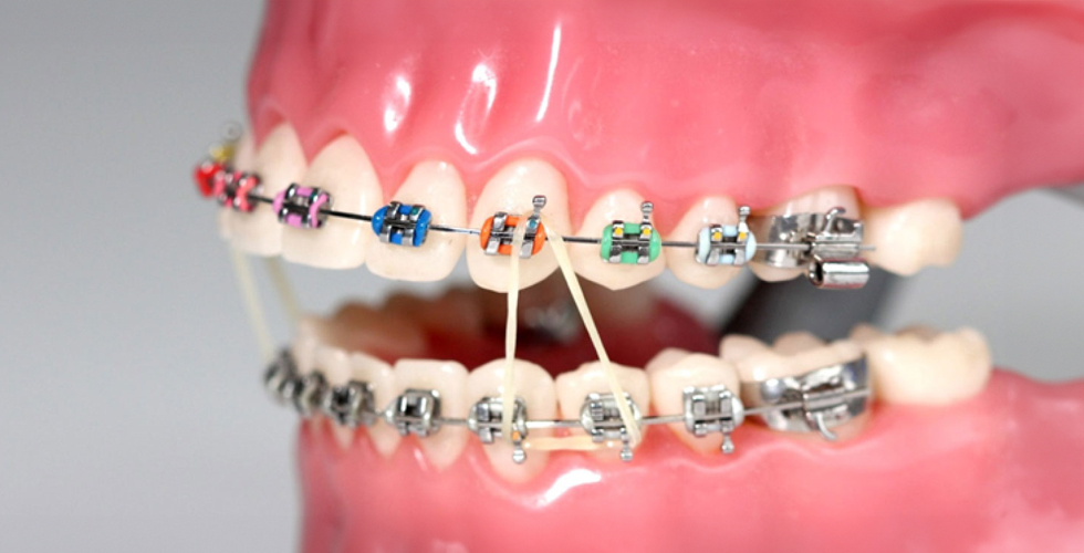 Braket Nedir ve Çeşitleri Nelerdir?