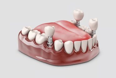 Dental İmplant