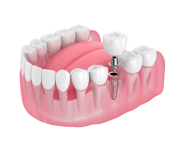 dental-implant