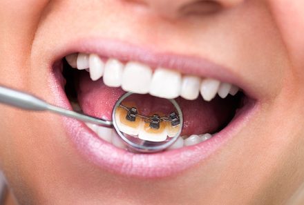 Lingual Ortodonti Diş Telleri Hakkında Bilmeniz Gereken 10 Şey