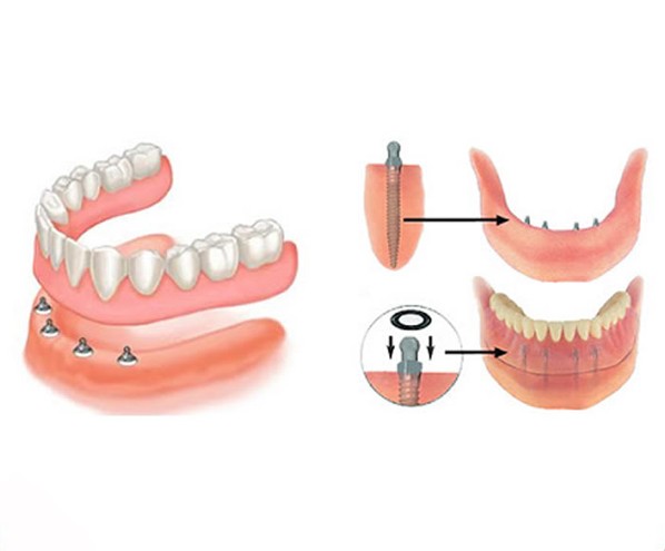 mini-dental-implant-2