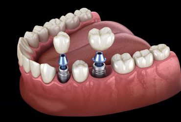 Mini Dental İmplant